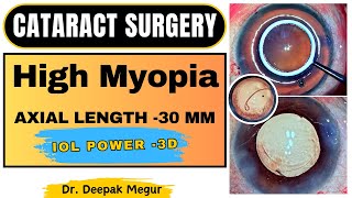 Cataract Surgery In High Myopic Eye Axial Length -30 Mm Iol Power -3D - Dr Deepak Megur