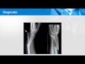 Conftube ECNi #126 -  Fractures du radius  - topo