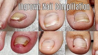 Ingrown Toenail Cleaning Compilation