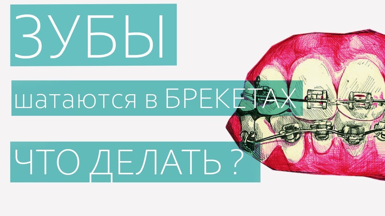 ЗУБЫ ШАТАЮТСЯ В БРЕКЕТАХ. ЧТО ДЕЛАТЬ?