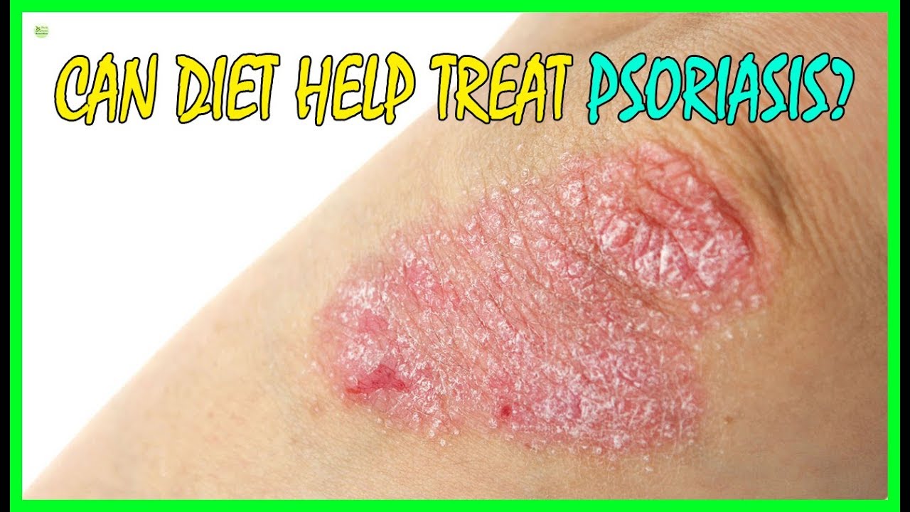 Can Diet Help Treat Psoriasis? | Best Home Remedies 