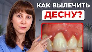 видео: БЫСТРЫЙ способ снять воспаление десны ДОМА! Что будет, если не лечить ГИНГИВИТ? картинка: БЫСТРЫЙ способ снять воспаление десны ДОМА! Что будет, если не лечить ГИНГИВИТ?