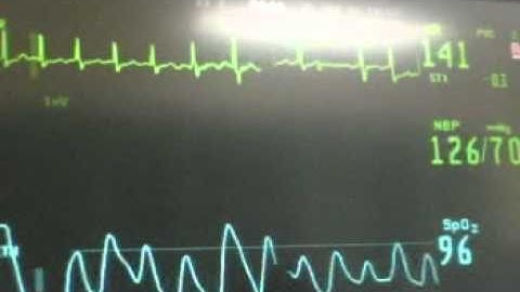 SVT to Sinus Conversion with Adenosine