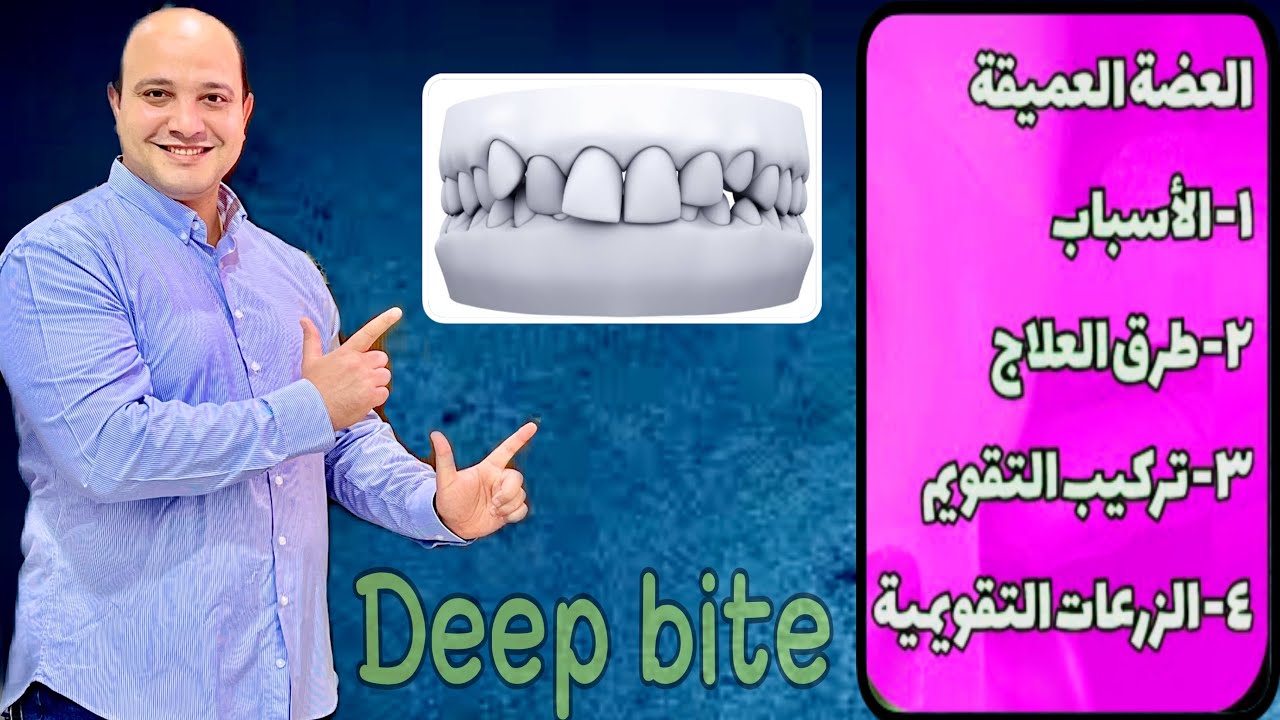 العضه العميقة | أسباب ، مشاكل ، طرق العلاج ، تركيب التقويم ، دور الزرعات التقويمية #لايك #اشتراك