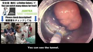 Sample Video ① Colonic ESD  -Rectum (Recurrence after EMR) -by Ohata Endosalon -