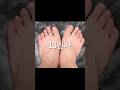 #무지외반증교정 15일차 - 발가락 힘 기르기 #foot