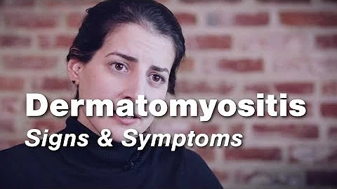 Dermatomyositis  Signs & Symptoms | Johns Hopkins