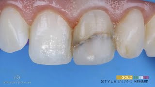 Direct composite bonding-veneer for single tooth discolorations.