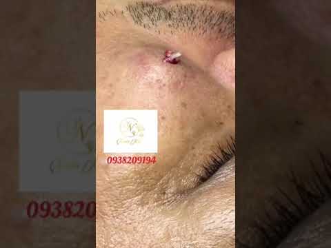 Video Cách nặn mụn bọc lâu năm khổng lồ trên mặt - khuyến... - youtube