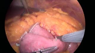 Laparoscopic Gastric Bypass At İrmet Hospital