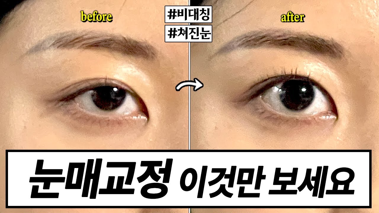 Внимание всем, кто открывает глаза лбом! Физиотерапевт объясняет, как исправить асимметрию глаз, ...