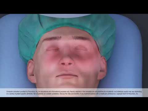 Animation of Thrombectomy
