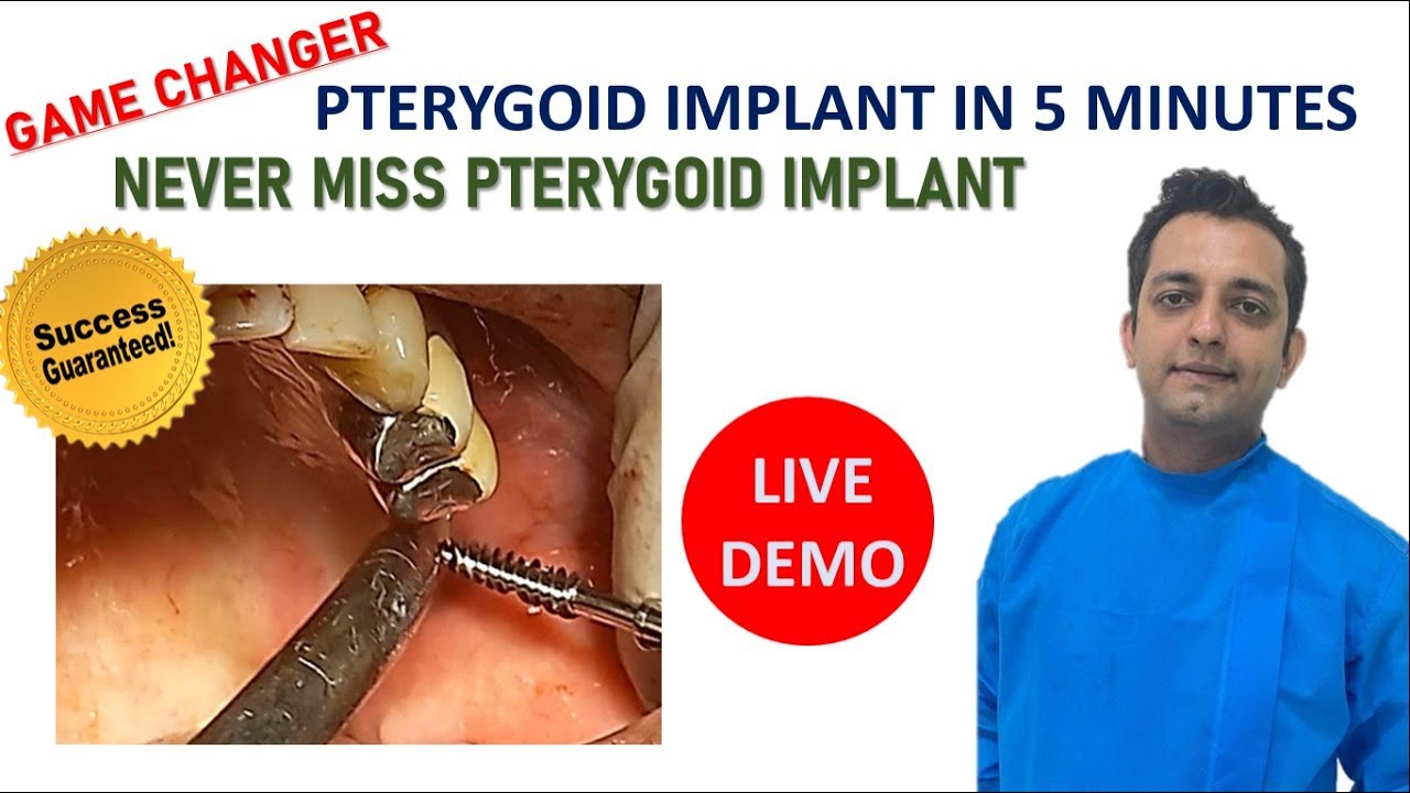 Pterygoid Implant In 5 Minutes NEVER MISS PTERYGOID IMPLANT YouTube
