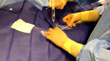 Radial Artery Access for Heart Catheterization by Dr Sanjay Patel