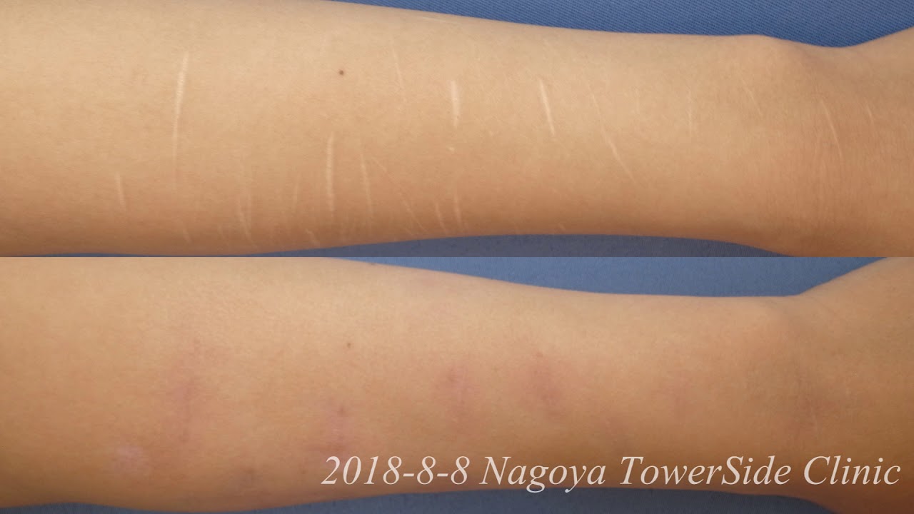 リストカット跡治療5 Wrist Arm Scar Removal 5 Youtube