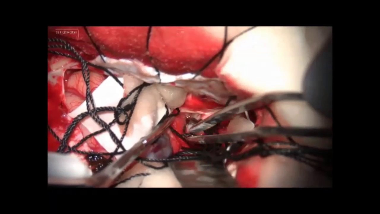 cerebral aneurysm, microsurgical clipping, intraoperative rupture, posterio...