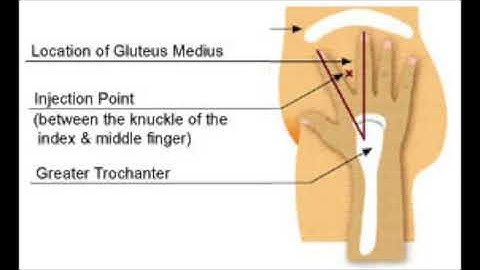 How to Inject Testosterone Seated Vent Glute | Spark Hormone Therapy