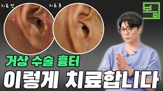 거상 수술 후 생긴 흉터, 이렇게 치료합니다