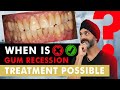 Gum Recession - Is there a cure?