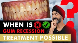 Gum Recession  Is there a cure?