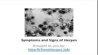 How to Treat Herpes
