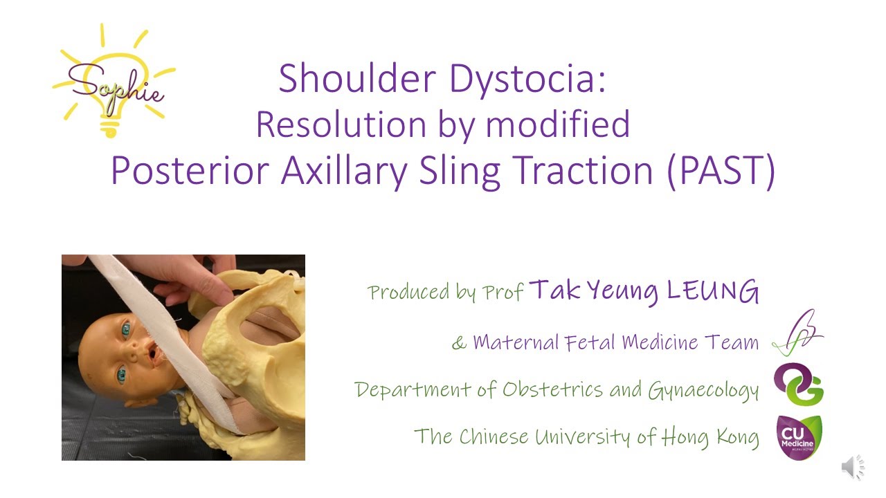 Shoulder Dystocia Resolution by modified Posterior Axillary Sling