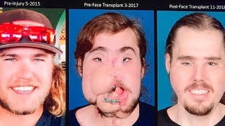 Face transplant patient reveals his incredible transformation