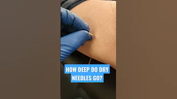 Ist Dry Needling gefährlich?