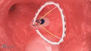 Valcare AMEND Transeptal Mitral Repair annuloplasty NF1021