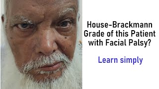 How To Determine The House-Brackmann Grade Of A Patient With Facial Nerve Palsy With Simple Tricks
