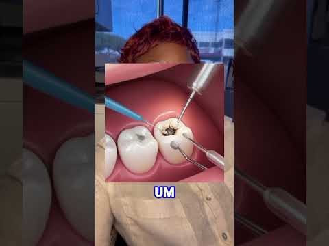 Don't Skip that tooth filling!!! #toothdecay #dentalclinic #dentalcare #toothfilling #cavities