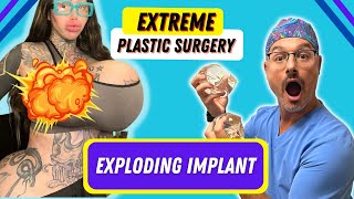 Huge Breast Implants - Extreme surgery by Matthew Schulman MD 7,419 views 1 year ago 3 minutes, 38 seconds