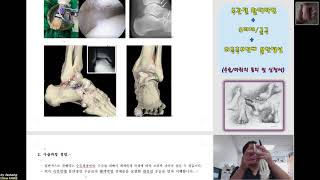 311.(수술마취.동의/신청서) [[족관절 활액막염 + 유리체/골극 + 외측측부인대 불안정]] 설명 [강찬.정형외과.충남대병원.Chan KANG]
