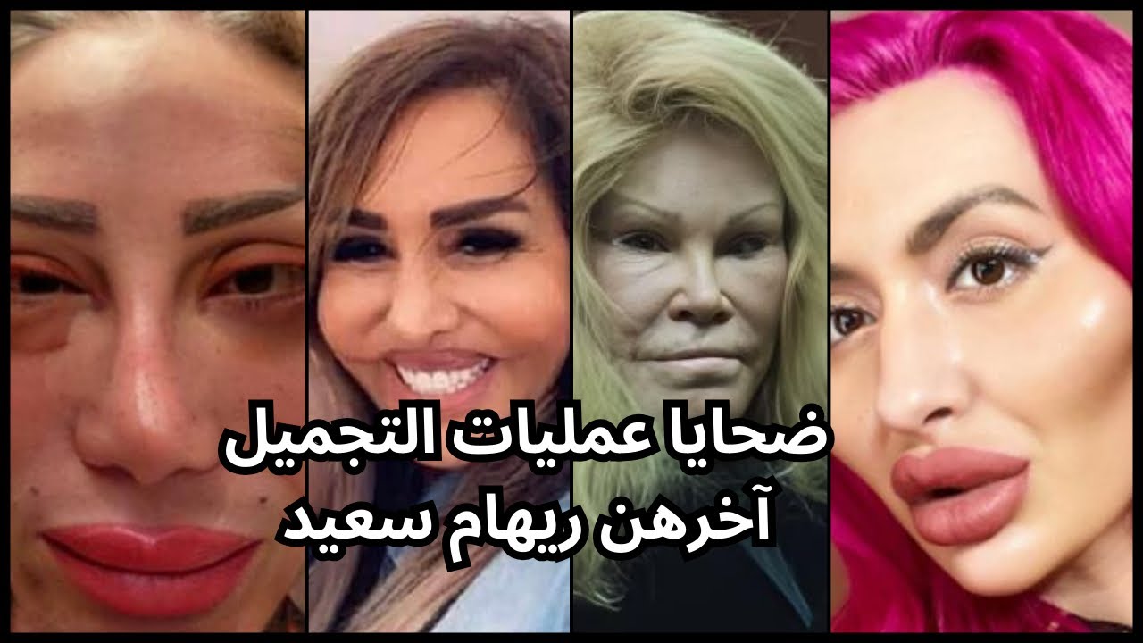 تشوه خطير لوجه  مشاهير من جراء عمليات تجميل فاشلة آخرهم ريهام سعيد.