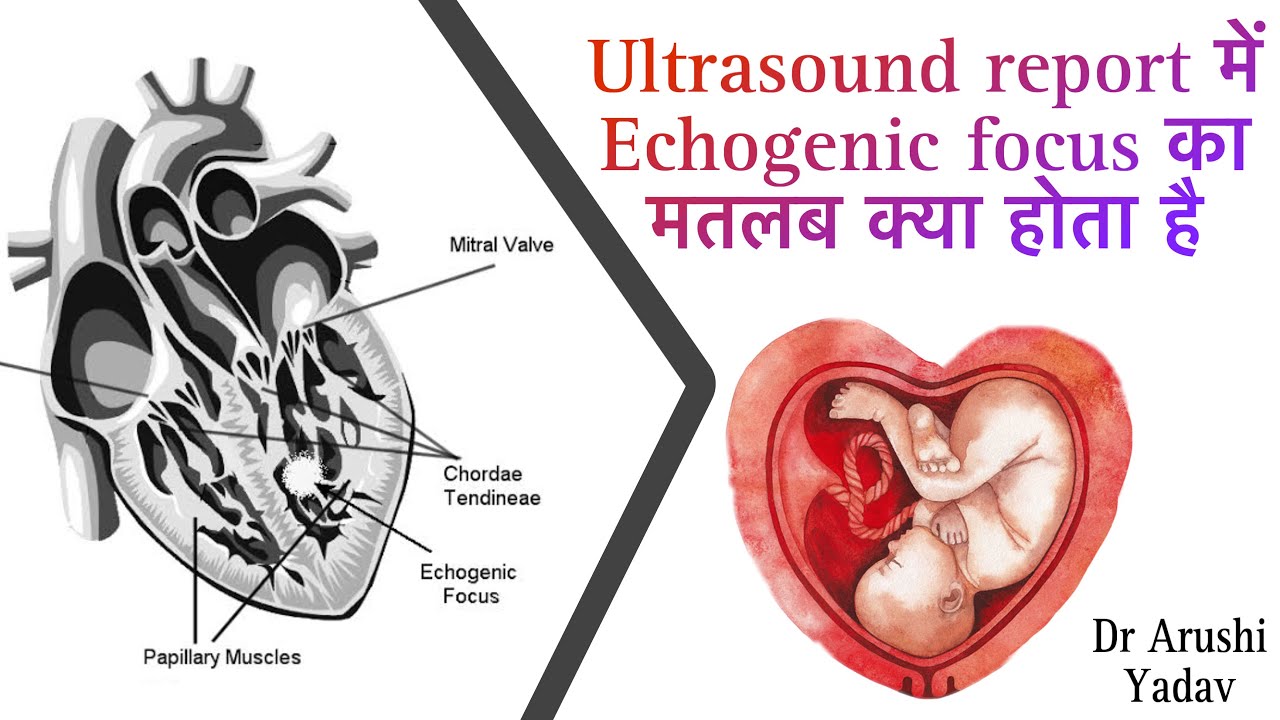 Ultrasound report मे echogenic focus क्या होता है | Echogenic focus in fetal heart | 