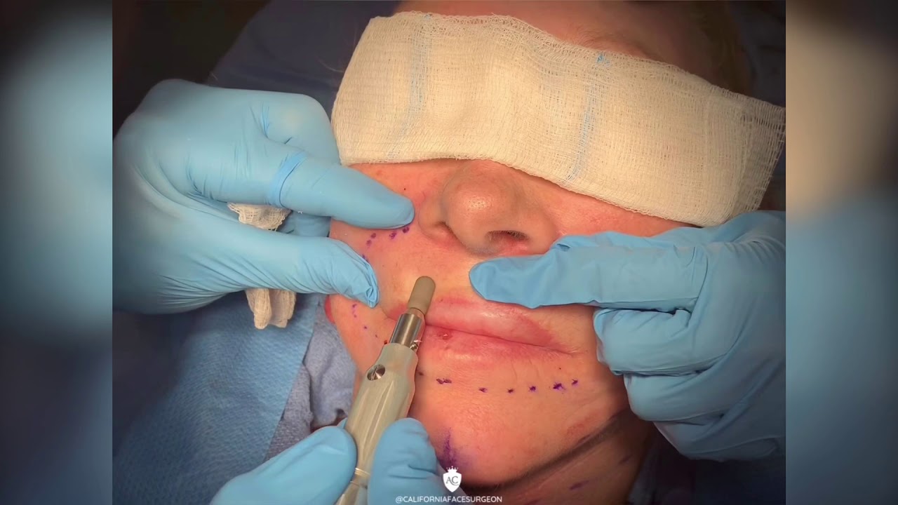 Dermabrasion YouTube