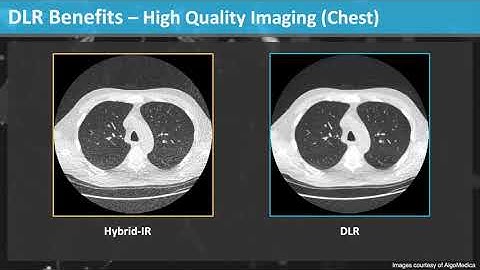 Increase Productivity and Clinical Decision Support through Deep Learning CT Image Processing