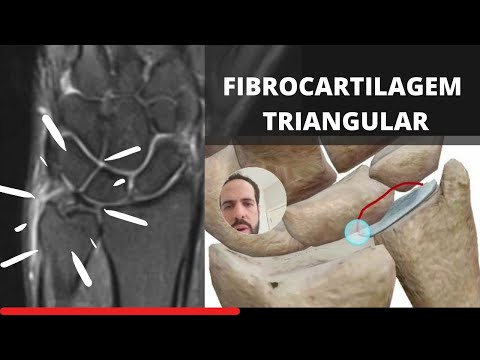 Fibrocartilagem Triangular - Tratamento