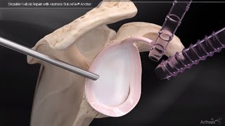 Shoulder Labral Repair with Knotless SutureTak® Anchor