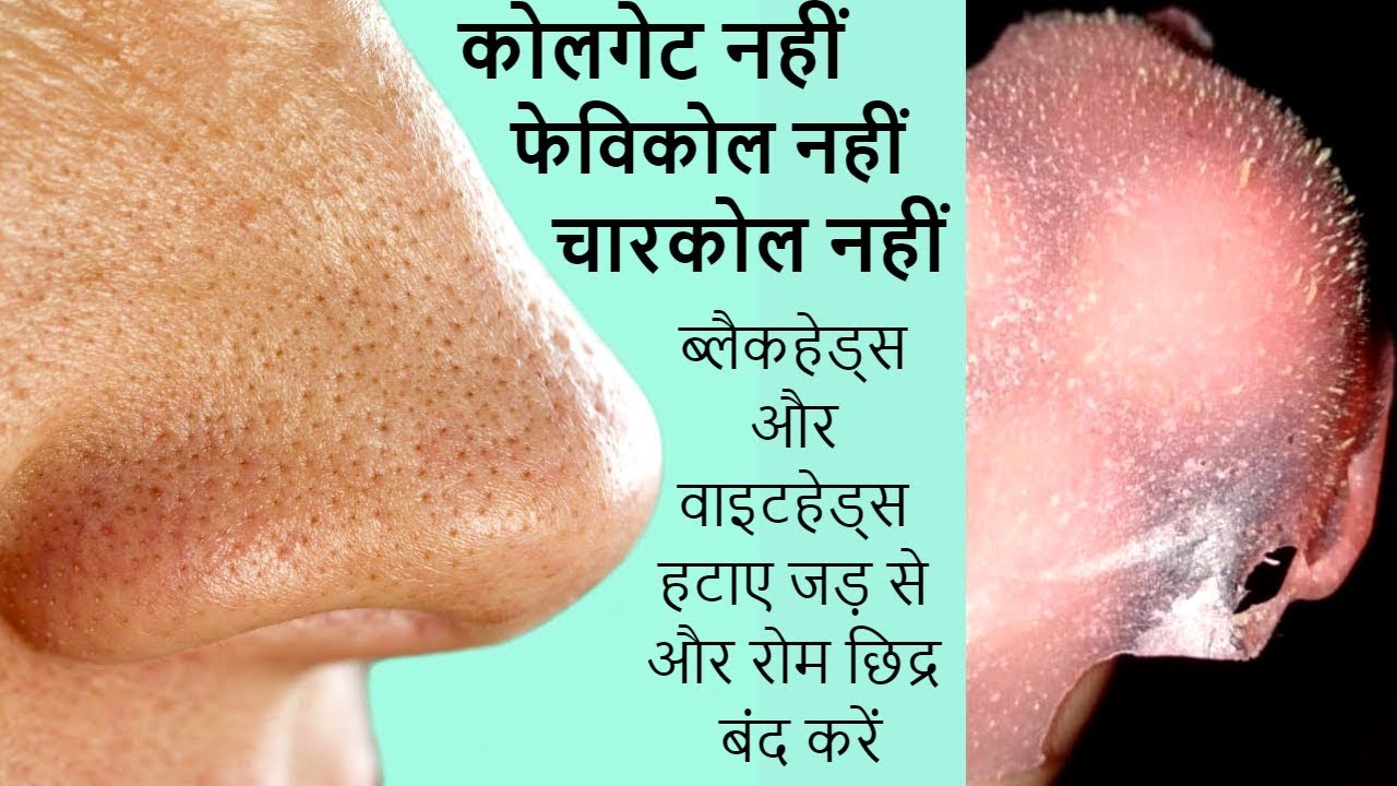 face mask amazon Use this 1 time and your blackhead like never before 100% working|Magical Blackhead remover at home|