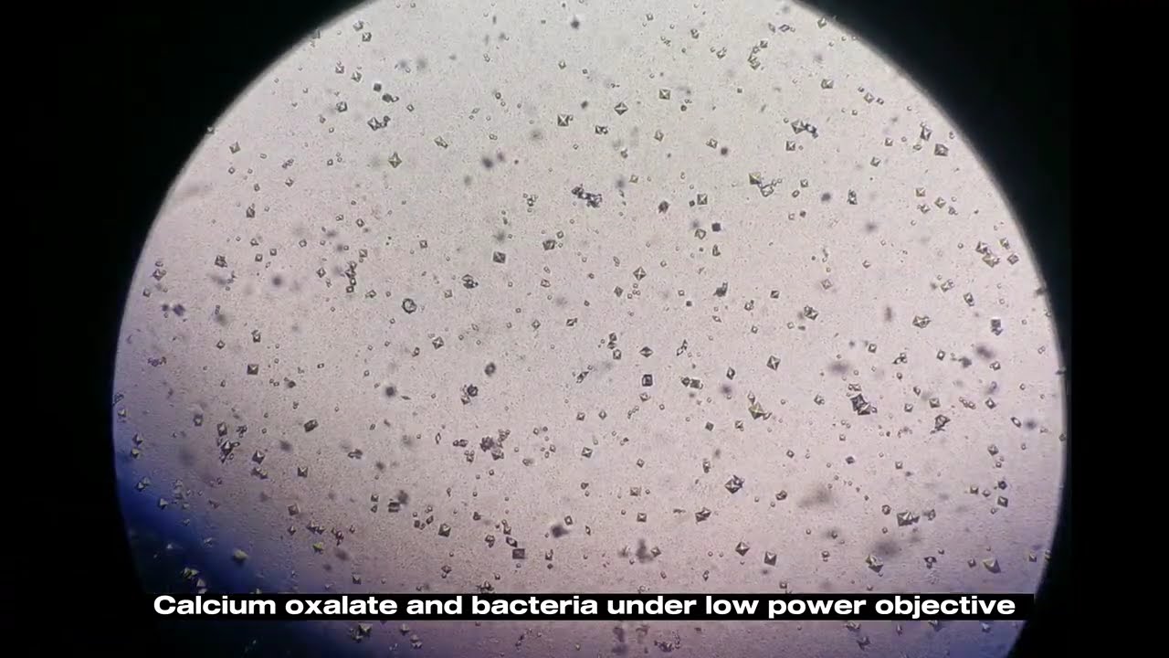 Calcium oxalate under the microscope | MEDICAL LABORATORY SCIENCE