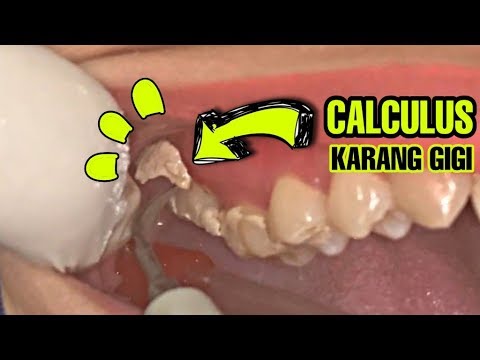 Pembersihan Karang Gigi Scaling Dokter Gigi 