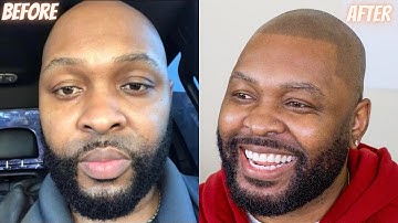WATCH THIS Scalp Micropigmentation Review in Houston, TX