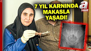 Baş Ağrısı Diye Gitti Karnında Makas Çıktı 7 Yıl Karnında Makasla Yaşadı A Haber
