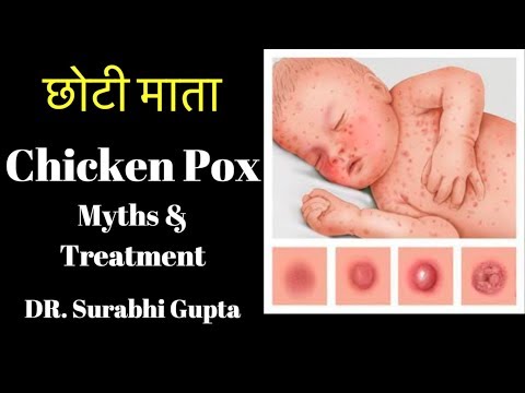 Video: Chickenpox And Newborn
