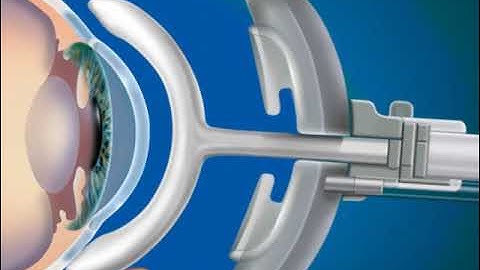 3 Disp Insertion Animation   LowRes