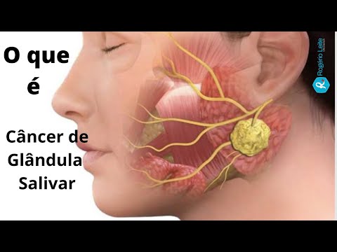 Vídeo: Câncer De Glândula Salivar