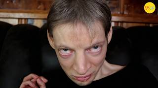 Living with "The Cat Cry" Syndrome (Cri Du Chat) Profile