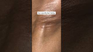 Celebrity Underarm Extracted #laserhairremoval #ingrownhair #ingrownhairremoval #foryou #treatments #waxing Profile