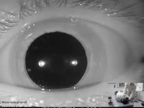 Right Posterior Canalithiasis with Gaze Separation - YouTube